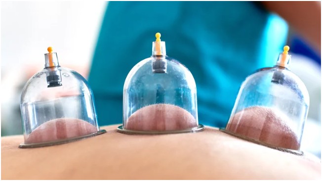 Understanding Hijama Cupping Therapy