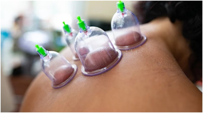 Hijama in the Modern Healthscape of Sydney