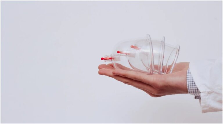 Hijama Sydney: The Ancient Art of Cupping Therapy