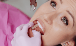 Planning Your Wisdom Teeth Extraction What to Expect from Initial Evaluation to Surgery